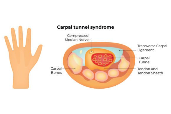 Download Carpal Tunnel Syndrome Science Design - Design Collection